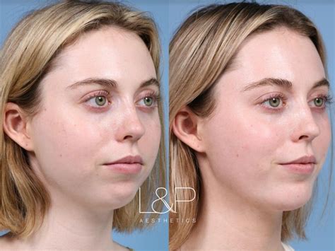 buccal fat removal norge pris|Fettsuging Oslo: Permanent Fettfjerning / Pris lipo.